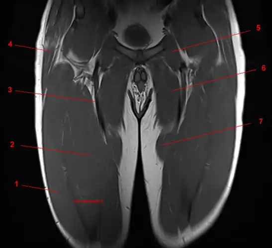 MRI Screening of Thigh